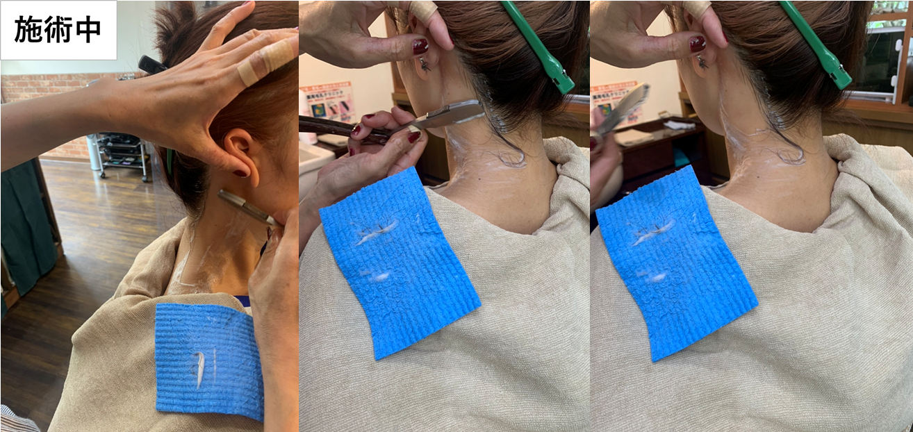 シェービング施術中写真